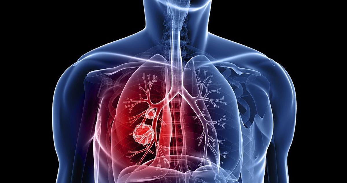 کشف روش جدیدی برای درمان سرطان