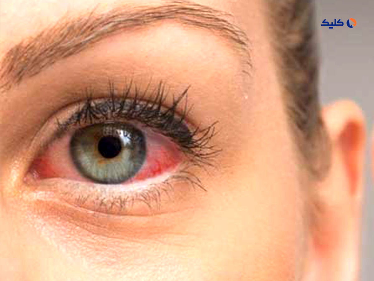 پروبیوتیک خوراکی نویدبخش درمان بیماری خشکی چشم